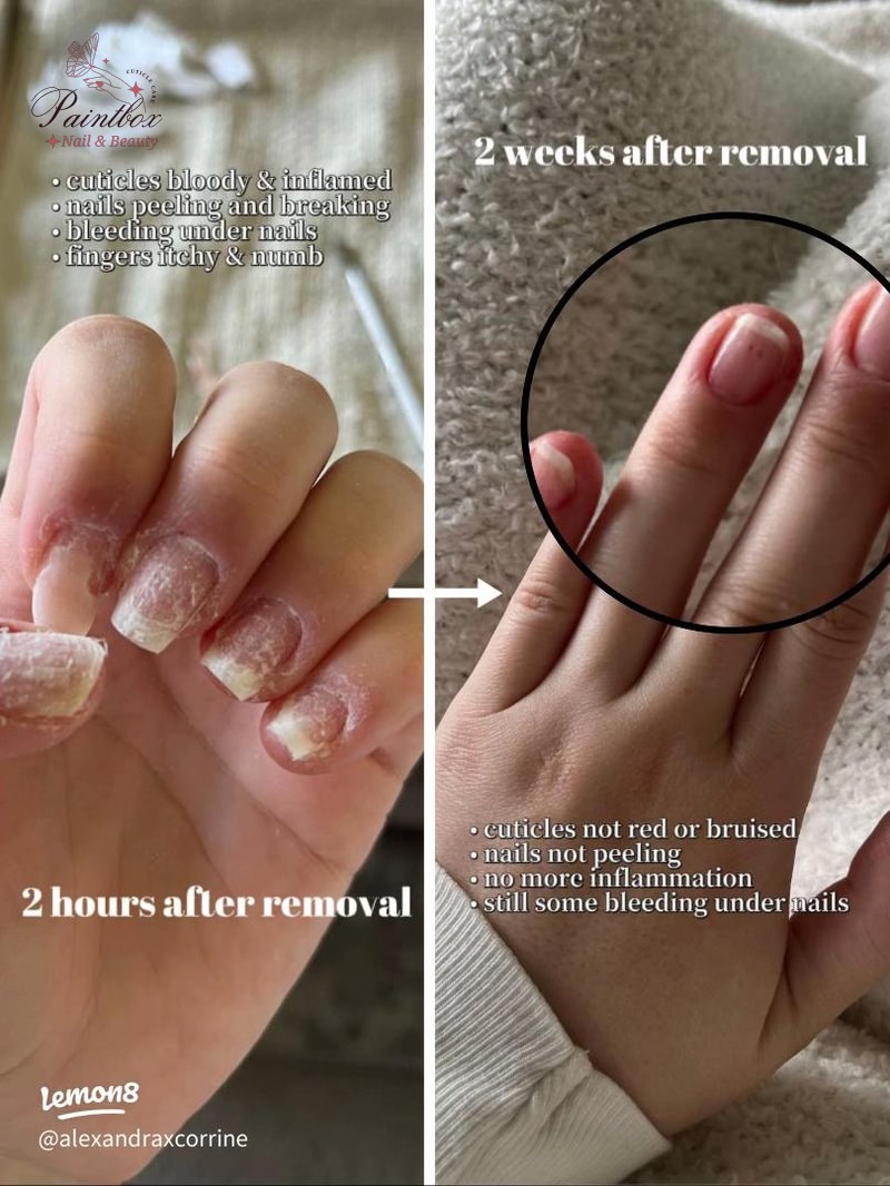 My Gel Nail Allergic Reaction: Inflamed Cuticles, Damaged Nails & My  Healing Journey