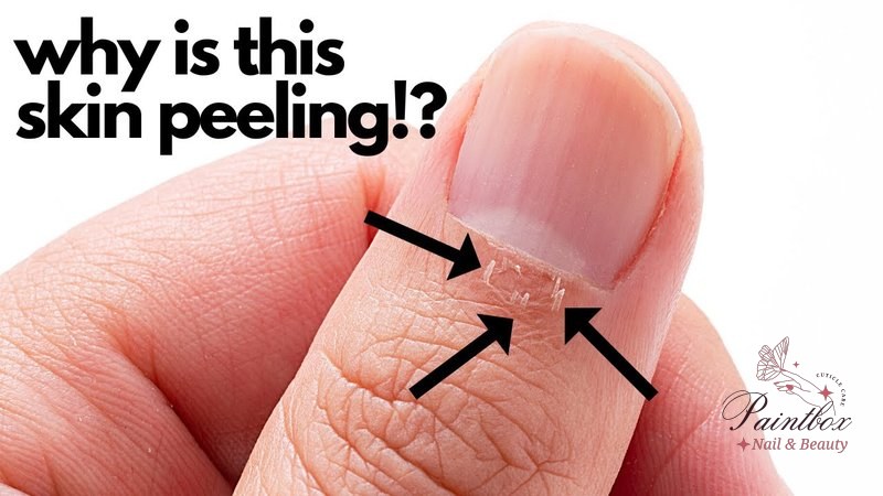 Skin Peeling After a Manicure?