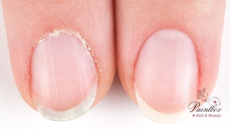 Overgrown Cuticles: Causes, Treatment, and Prevention