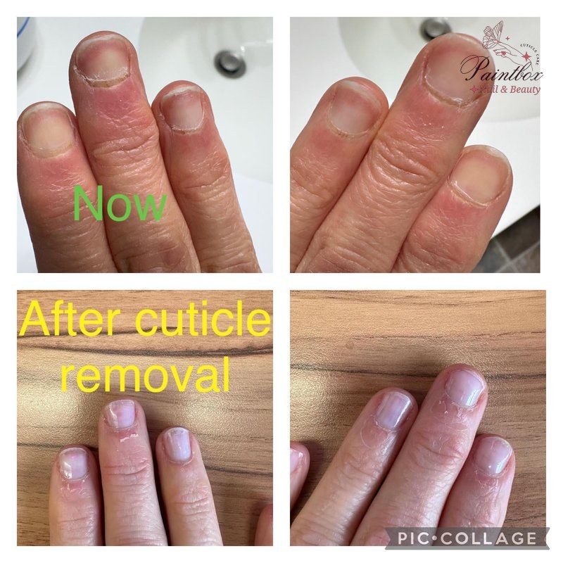 Frustration with persistent cuticle overgrowth